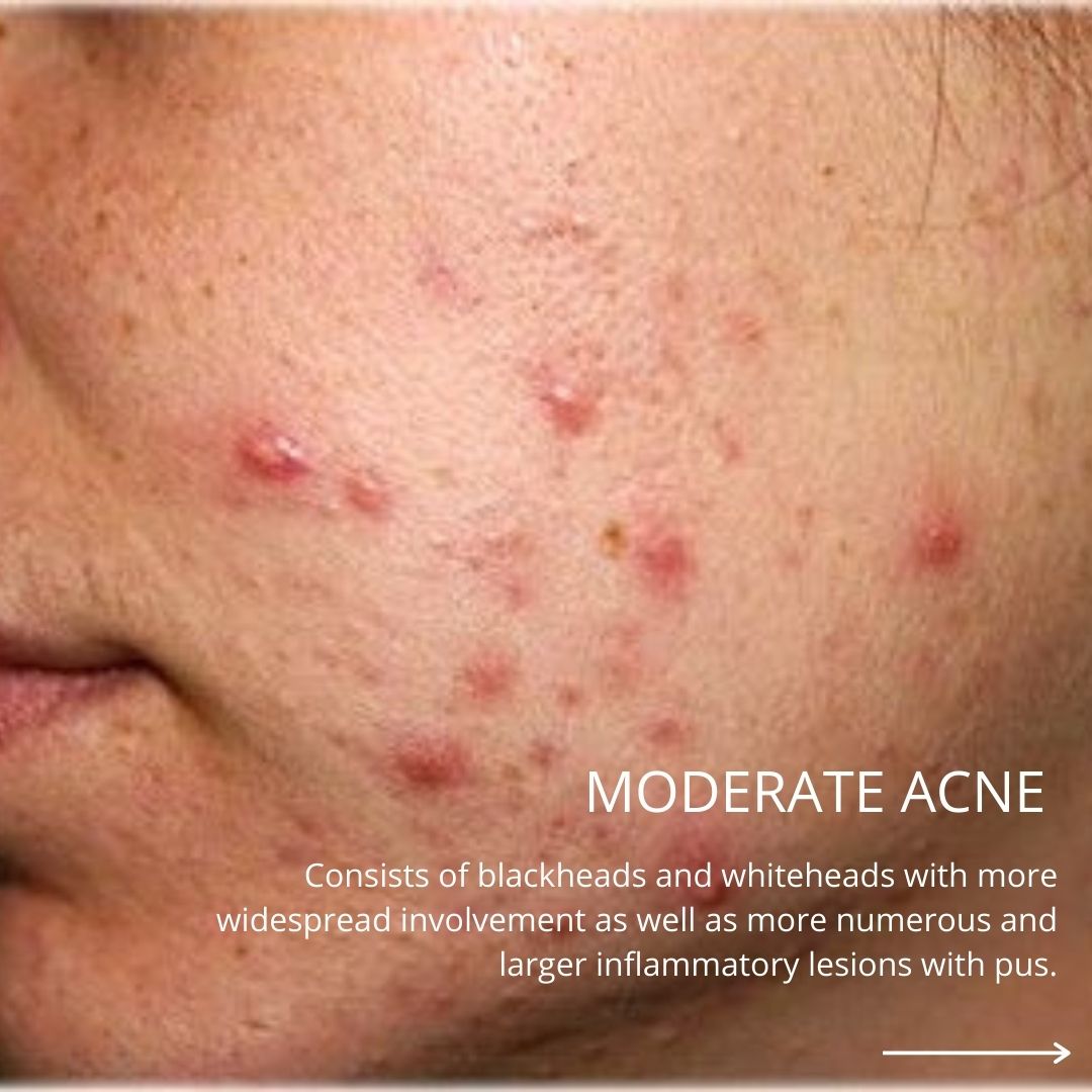 moderate acne on a patients cheek