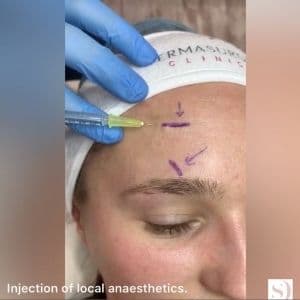 subcision procedure injecting anaesthetic