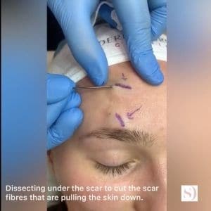 subcision procedure part 2