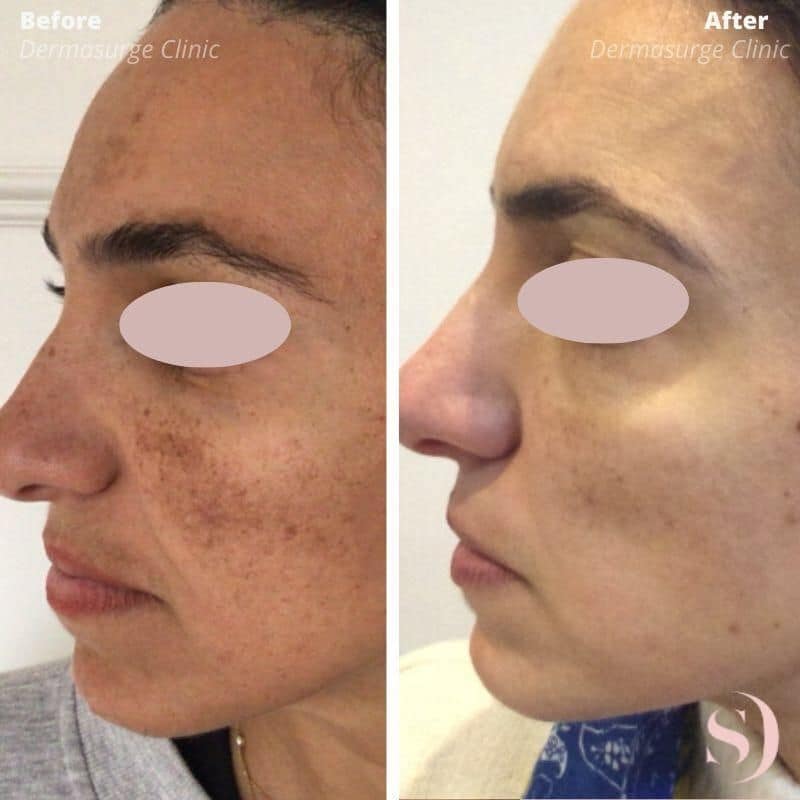 chemical peel side view