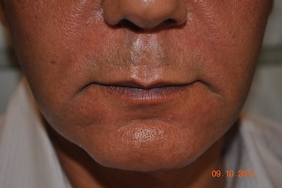 Droopy-Corners-Of-Mouth-condition-before