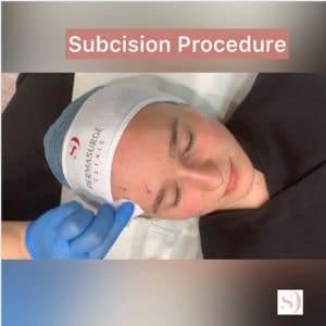 complete subcision procedure by Dr Injibar