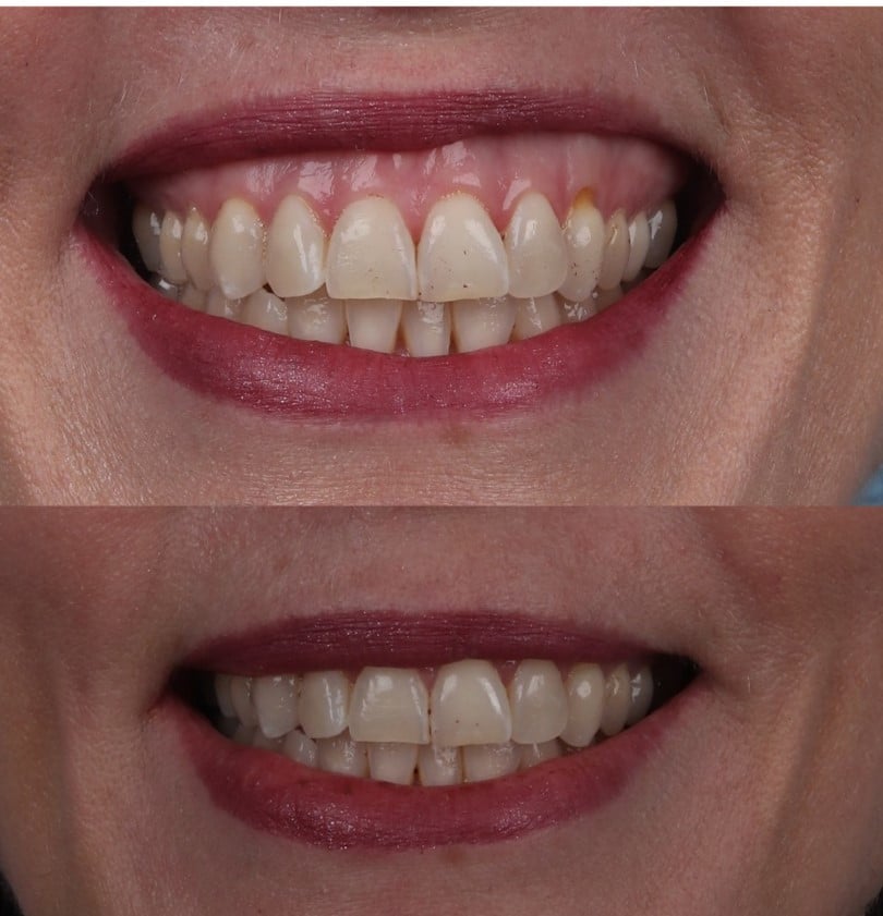 Before and After Photos of a surgical lip repositioning