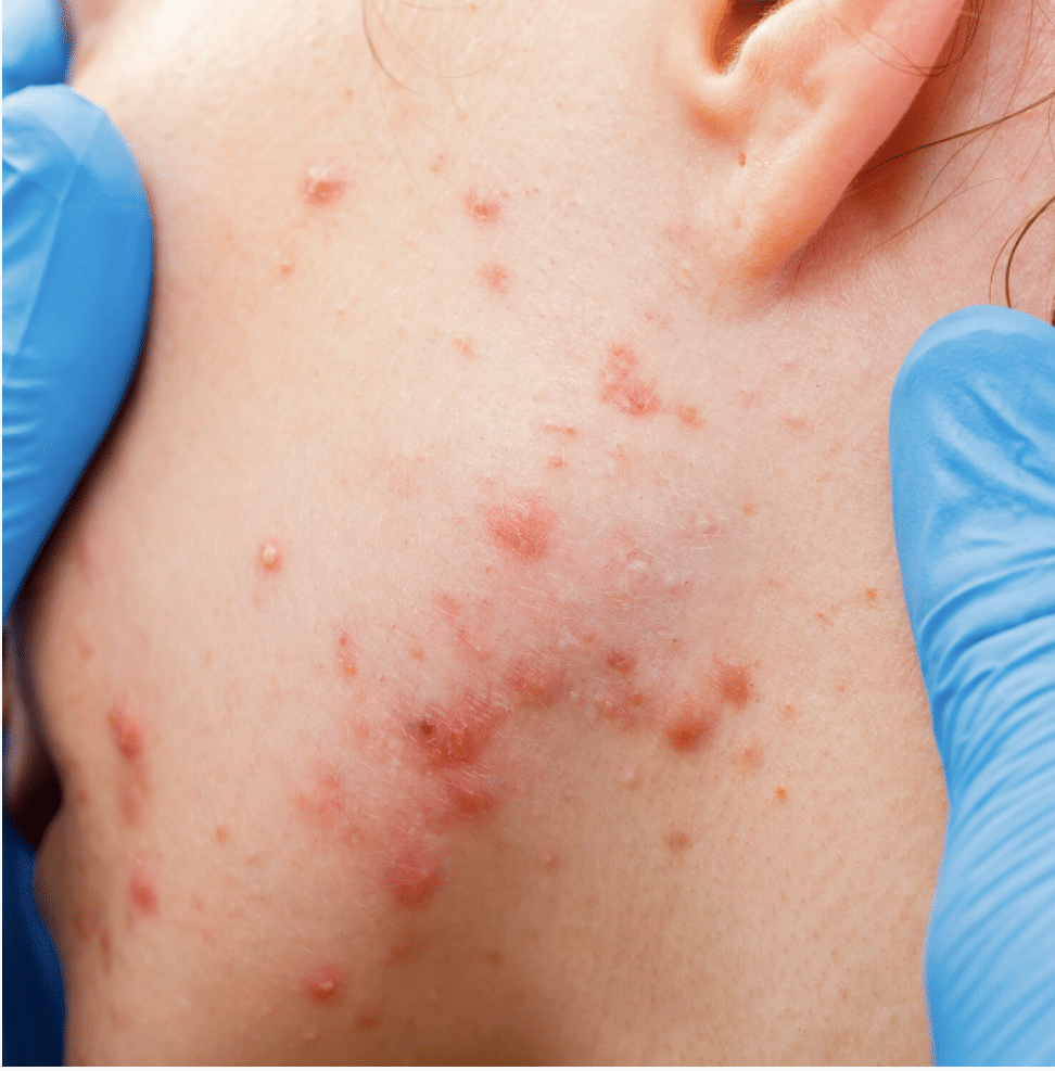 examination of acne at dermasurge clinic in Harley Street London