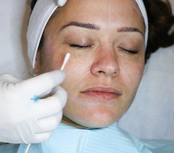 Experience the Benefits of a Chemical Peel
