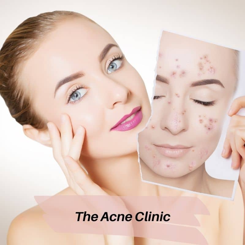The Acne Clinic