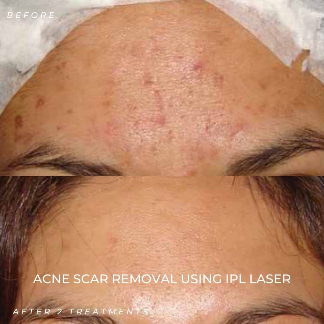 acne scar treatment ipl laser b a 
