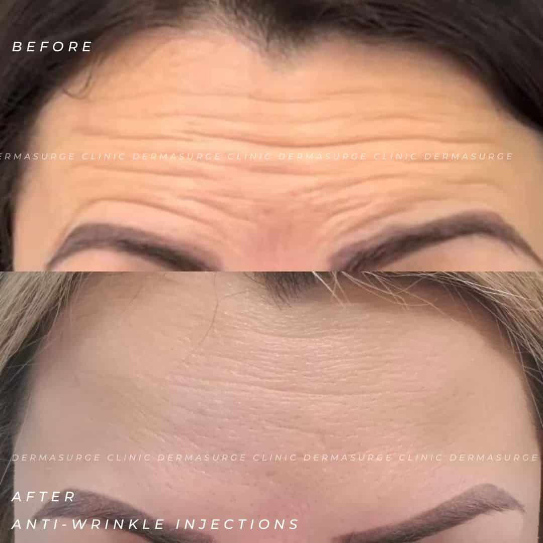before and after anti-wrinkle injection