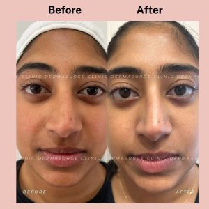 carbon laser facial treatment before and after photo