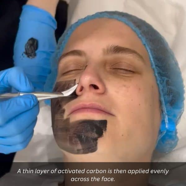 carbon laser facial step 2