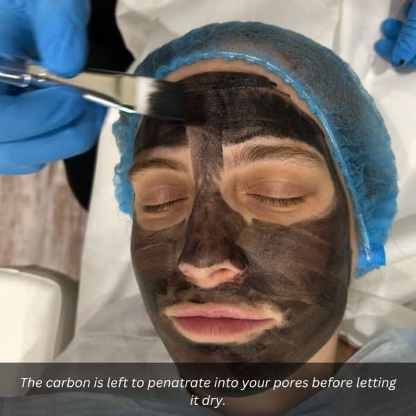 carbon laser facial step 3
