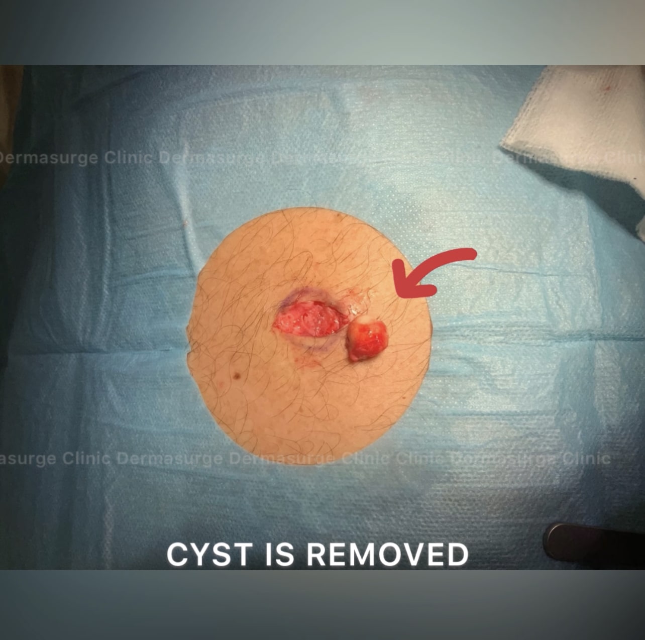 cyst: is removed