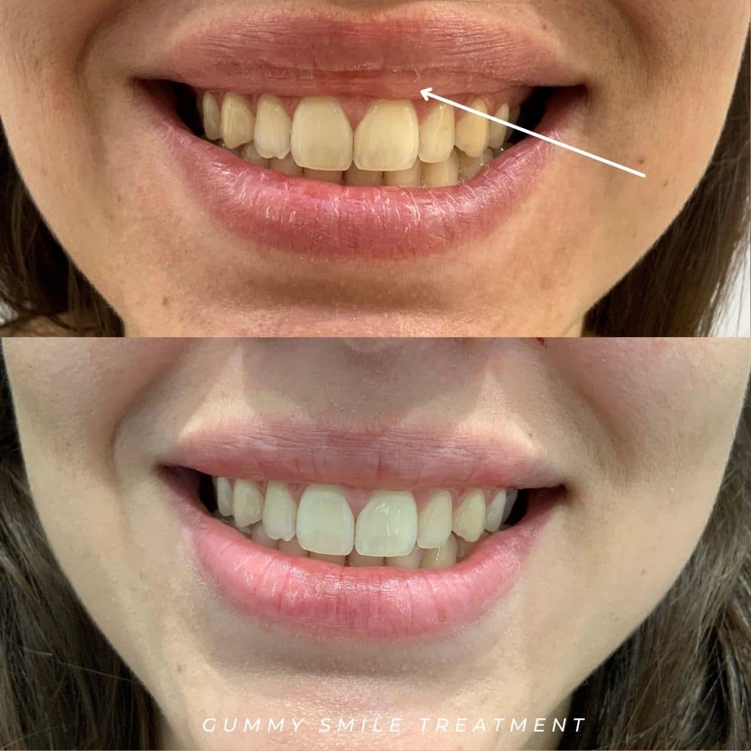 gummy smile before and after image