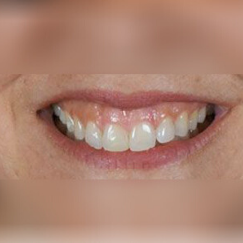 gummy-smile-dermasurge-clinic-london