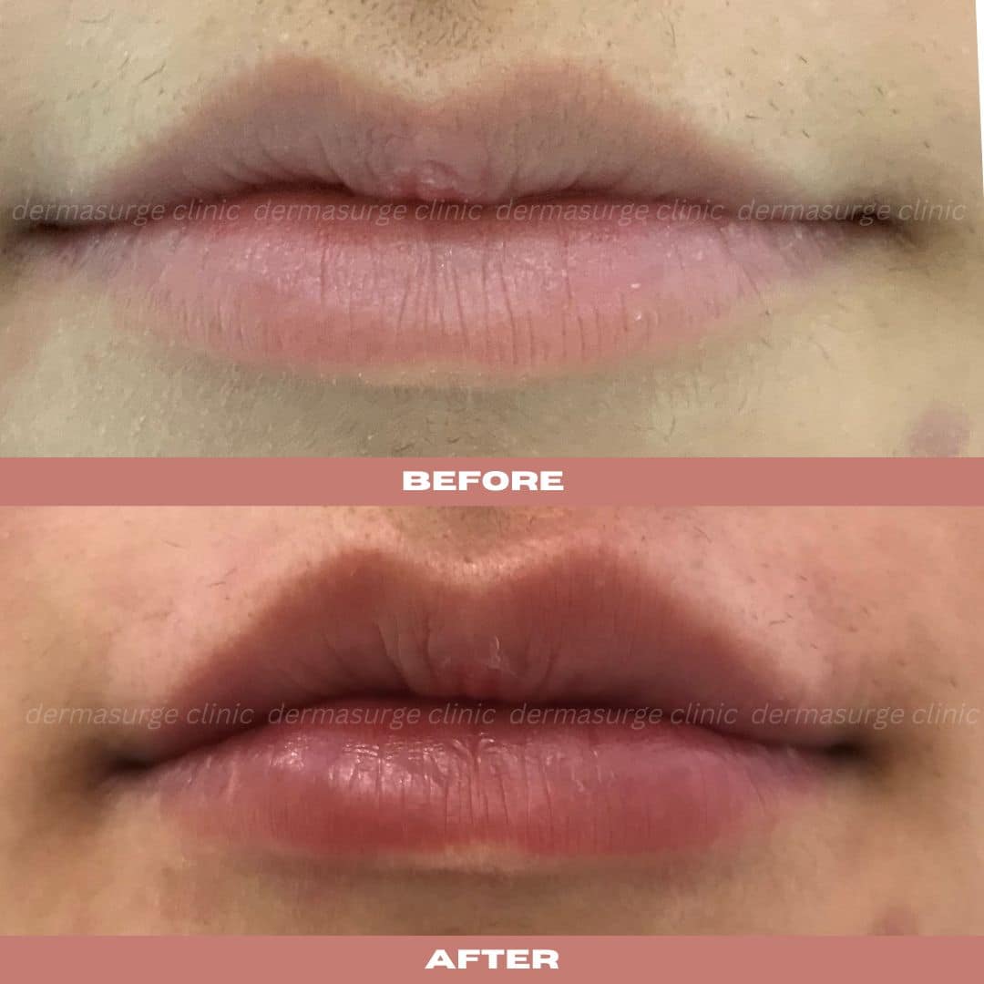lip augmentation b a 4
