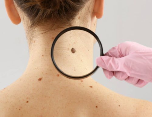 Understanding When to Get Moles Checked for Early Detection of Skin Cancer