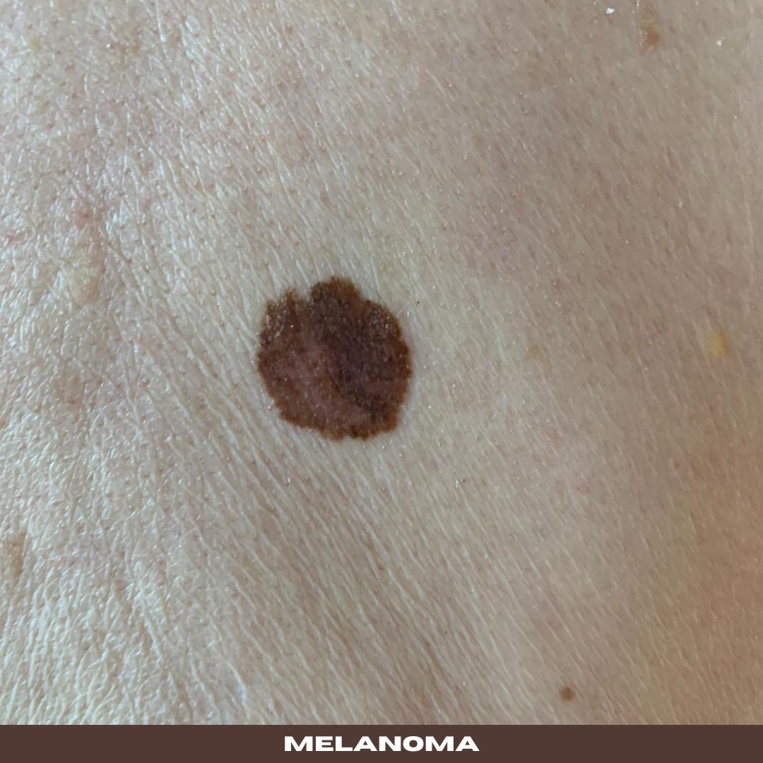 skin cancer Melanoma