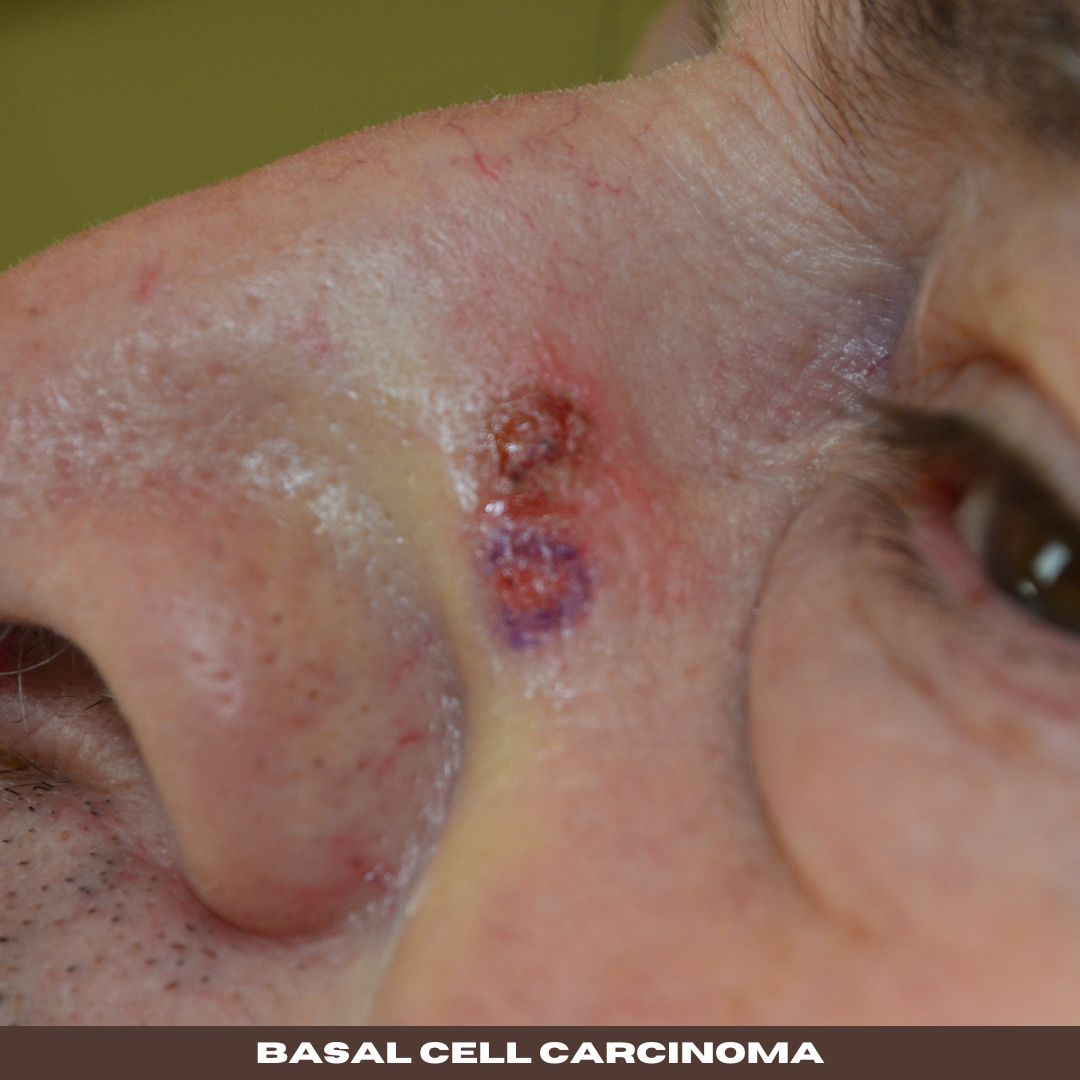 skin cancer Basal Cell Carcinoma