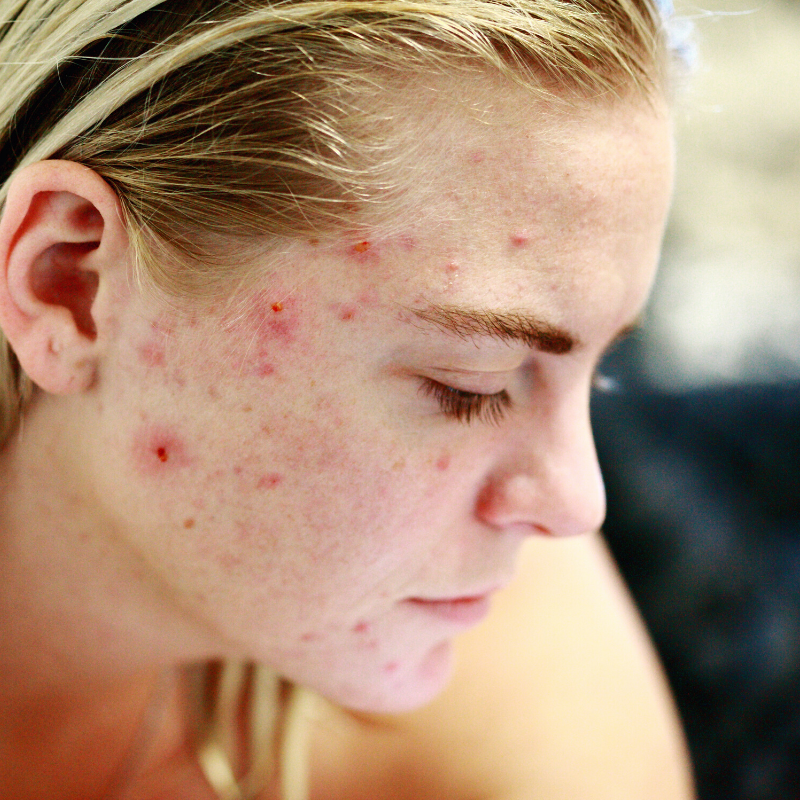 Best Teenage Acne Treatment | Demasurge Clinic